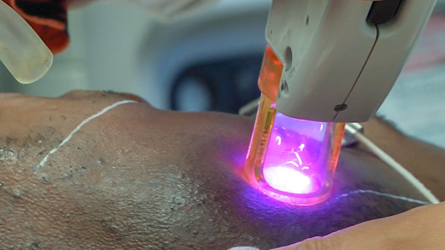 Illustrative laser hair removal treatment on a person's face; the image is not from Luna or a Luna client.