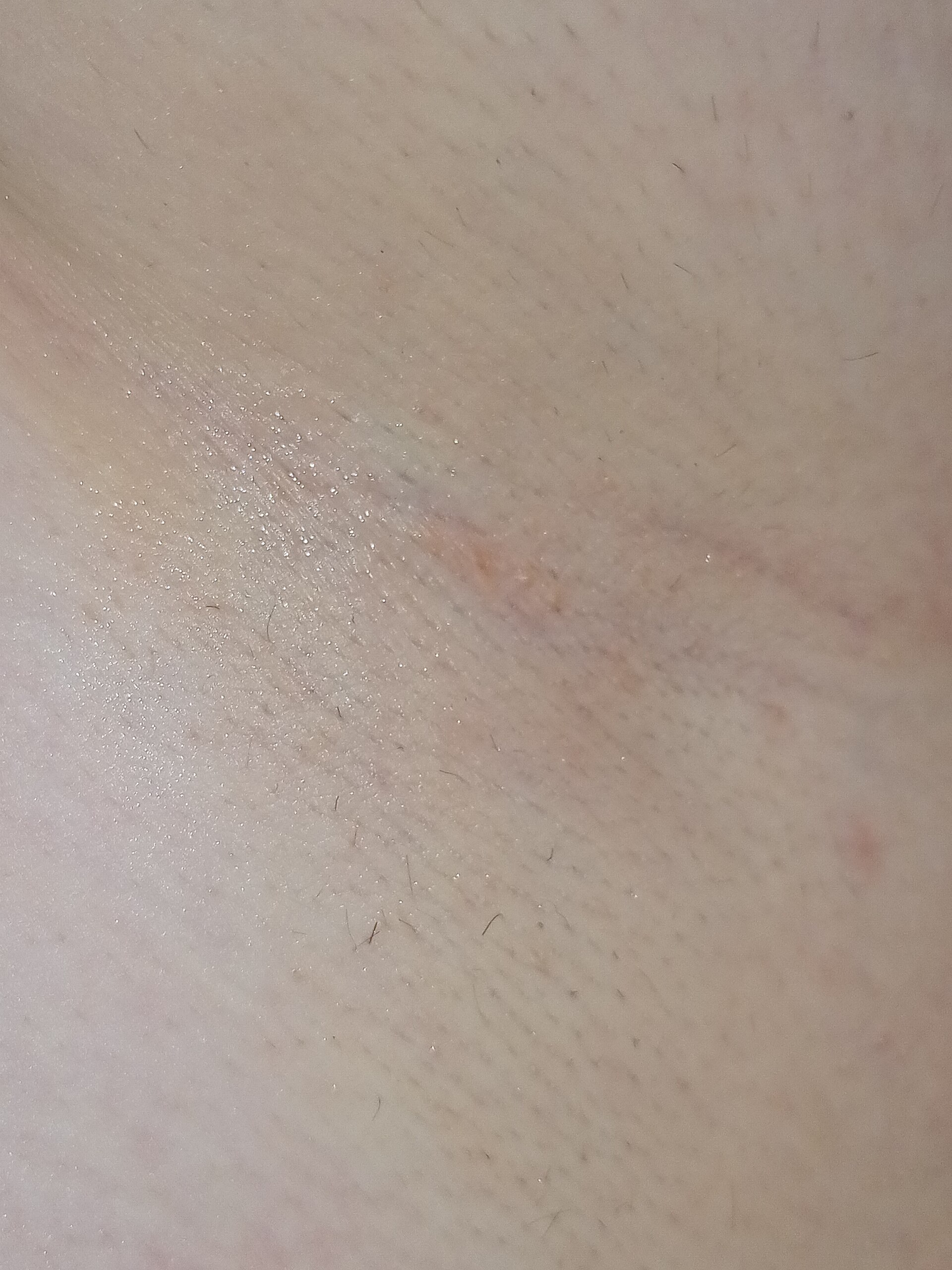 Illustrative close-up of an underarm after laser hair-removal sessions; not a Luna client or a photo of Luna's clinic.